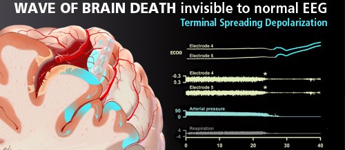 Terminal spreading depolarization and electrical silence in brain death